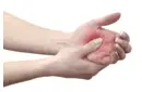 Kas Romatizması Neden Olur?