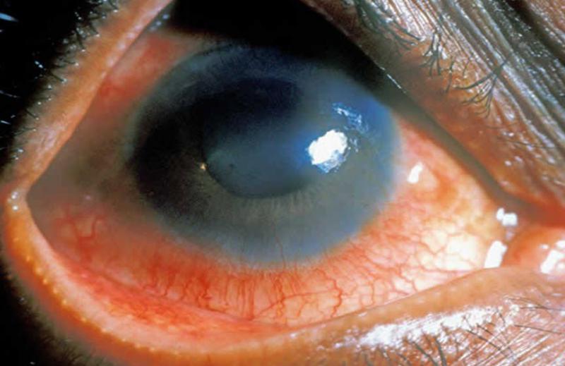 Romatoid Artrit Göz Bulguları